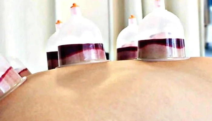 Aor Physiotherapy Rehabilitation Centre Alor Setar   Fisioterapi Stroke Urutan Bekam Akupunktur Skor - Alor Setar