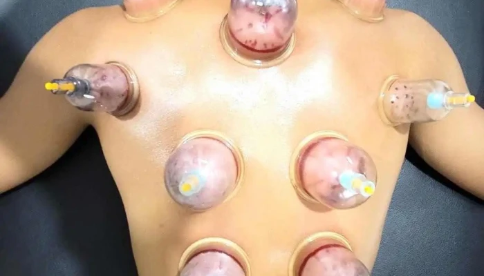 Bekam Terapi Sunnah (Cupping Therapy) - Lot 1287