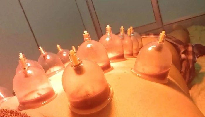 Bekam Urutan Resdung Terapi Tulang Saraf Al Fashdu By Sena Wellness Centre Harga - Kangar